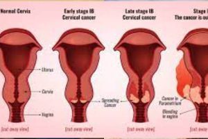 WOMEN, GIRLS URGED TO GO FOR CERVICAL CANCER SCREENING